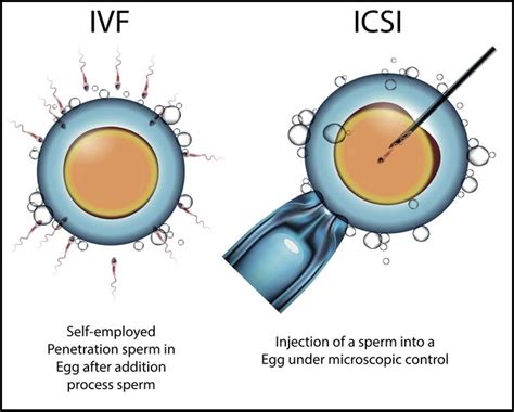 When is icsi used in ivf
