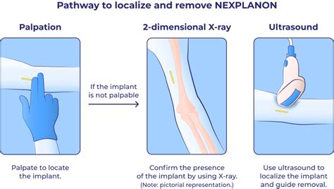 When is nexplanon not effective