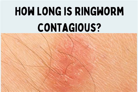 When is ringworm contagious in humans