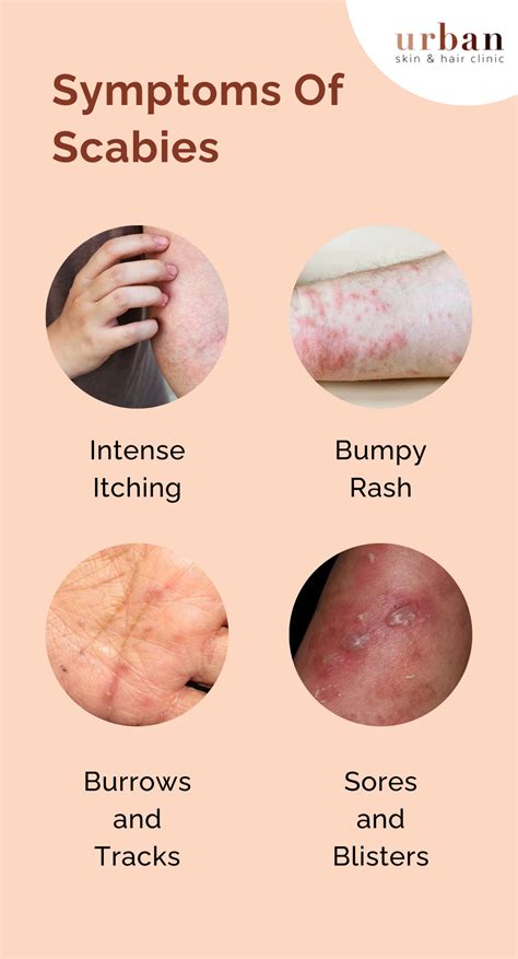 When is scabies not contagious
