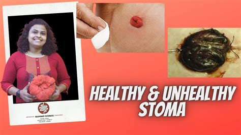 When should I be worried about my stoma? - The Healthy Journal