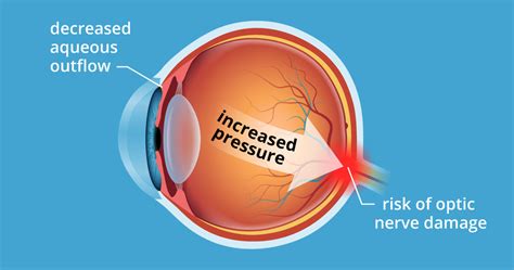 When should I worry about eye pressure? - emojicut.com