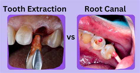 When should a tooth be extracted