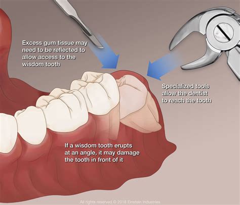 When should a tooth be removed