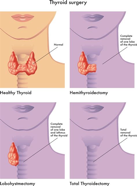 When should thyroid nodules be removed