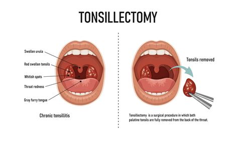 When should tonsils come out