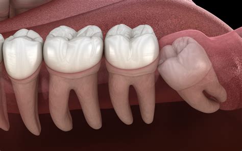When should wisdom teeth be pulled