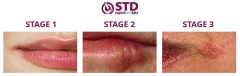 Where does herpes show up.  he/she/it form of do 2.  DOES definition: a p...