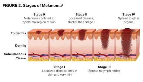 Where does melanoma metastasize? Know the melanoma stages