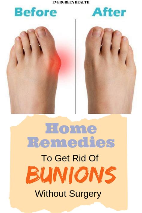 Which Bunion Treatment is Best for You? - The …