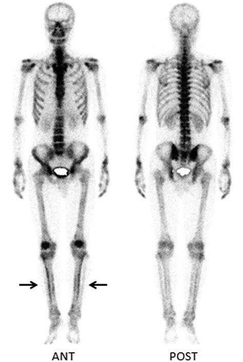 Which diphosphonate for routine bone scintigraphy …