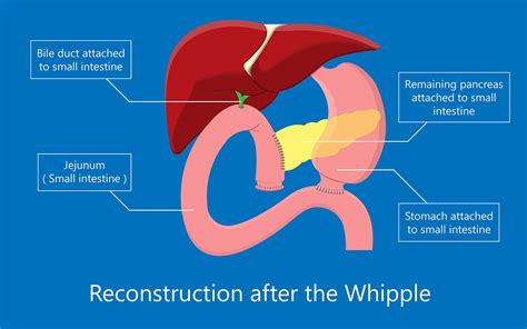 Whipple procedure Definition & Meaning Merriam-Webster Medical