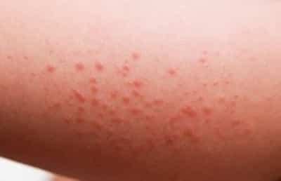 Boil on Inner Thigh: Symptoms, Causes, Treatment