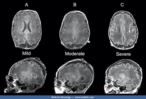 White Matter Injury in Term Newborns With Neonatal Encephalopathy