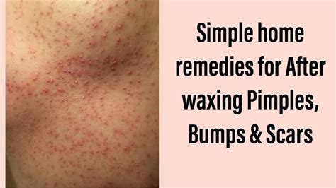 White bumps after a brazilian wax. After undergoing a Brazilian wax, achieving silky smooth skin is the ultimate goal. However, sometimes bumps can appear, causing frustration and discomfort. Don’t worry, we’ve got you covered! 