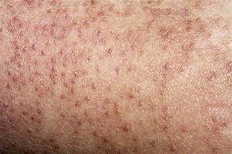 White bumps on inner thigh. These cysts contain a white substance composed of the protein keratin, which exists in the skin, hair, and nails. Sebaceous cysts. ... a bump on the inner thigh; a lump in the scrotum; 