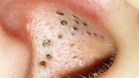 Big clogged pore contents expressed! Small cyst. Big sque