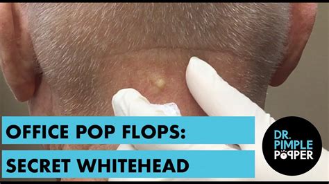 Whiteheads youtube. Apr 2, 2024 ... blackhead #whitehead Blackheads & Milia,Huge Nose acne blackheads extraction New This Week Pimple Popping. How to remove blackheads and ... 