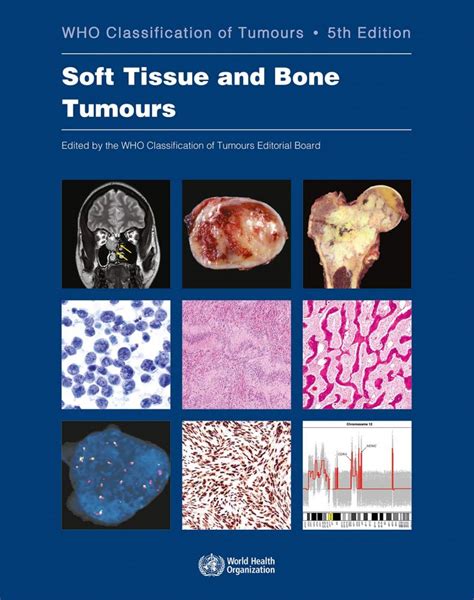 Who classification of soft tissue tumors. - La lingua francese nelle scuole tecniche e ginnasiali.