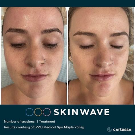 Who couldn’t use a SKINWAVE facial... - Cartessa Aesthetics