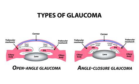 Who gets glaucoma the most