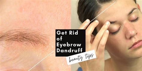 Why Do I Have Eyebrow Dandruff? 3 Simple Ways To …