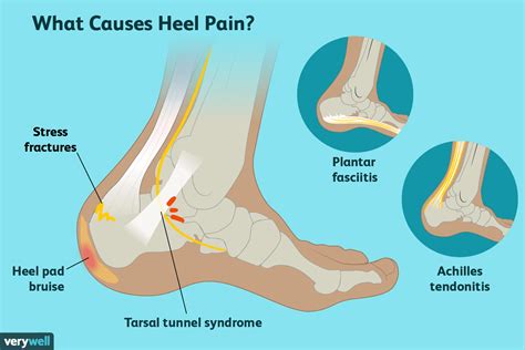 Why Does My Heel Hurt? Joint Replacement Institute