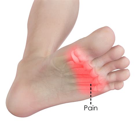 Why Does The Bottom Of My Foot Burn - FootProAdvice.com