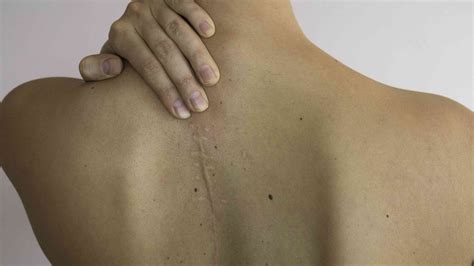 Why Scar Tissue Pain Occurs and What You Can Do About It - Healthline