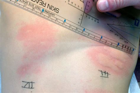 Why Skin Testing Is the Best Form of Allergy Testing Regional Allergy