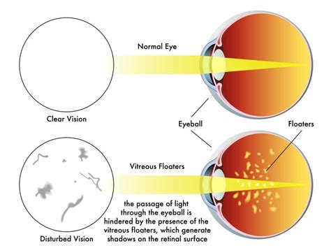 Why do I see rings or flashing lights in my field of vision? - Spec…