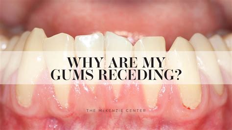 Why do gums recede around implant? - ibetha.dixiesewing.com