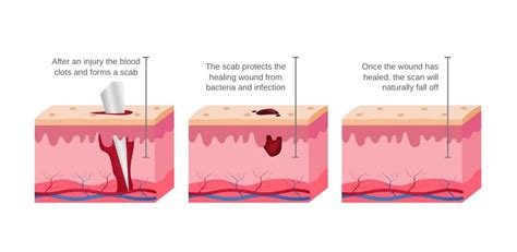 Why do i pick my scabs until they bleed - mdw.osteo-botzenhard.de