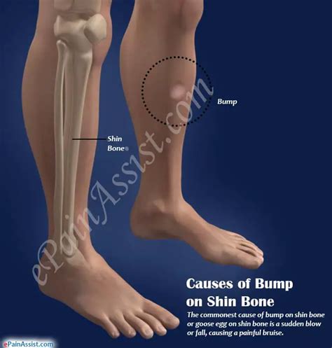 Why do my shin bones feel bumpy HealthTap Online …