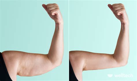 Why do womens arms get saggy?