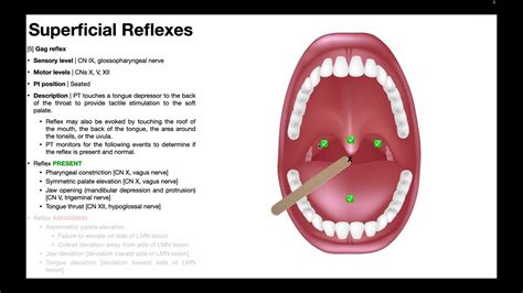 Why does my gag reflex keep triggering when I cough normally?