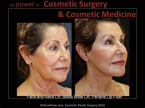 Why is it taking so long to heal after facelift? - Dr. Dean Kane