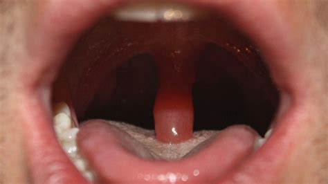 Skin is hanging from the tip of uvula and touching my tongue.Now having tickling sensation.No signs of sw ... Read More. Uvula enlarged 8258 Views My uvula is enlarged and touching the back of tongue.started 7 days back..It is troublesome.. ... I feel that uvula is touching my tounge I feel something is hanging at back of my mouth and it is .... 