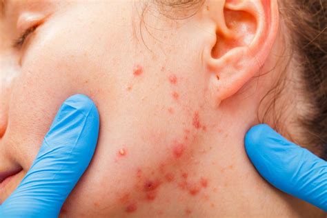 Why is there blood in pimples