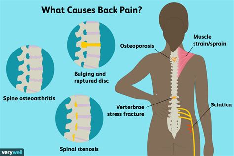 Why pain in end of back bone? - delasd.vhfdental.com