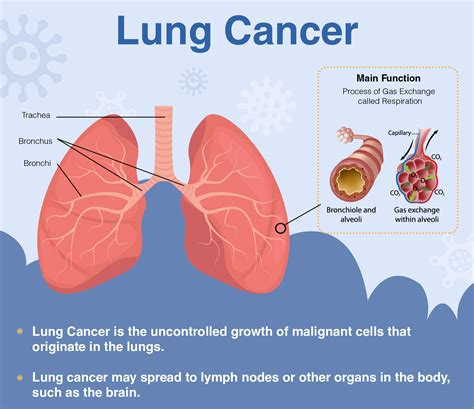 Why so many newly-diagnosed lung cancer patients already have advanced cancer