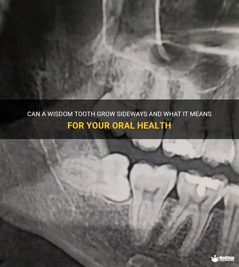 Why your Wisdom Tooth Grows Sideways in the Lower Jaw