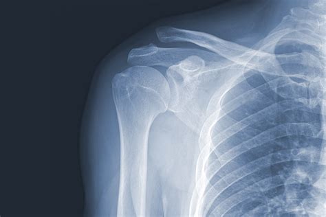 Will you have Shoulder pain with Multiple myeloma? - eHealthMe