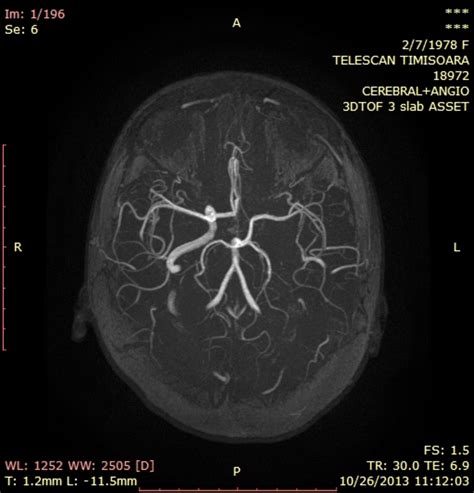 Willis circle mri.  Figure 2 - Cerebral arterial circle - MRI: TOF - Axi...