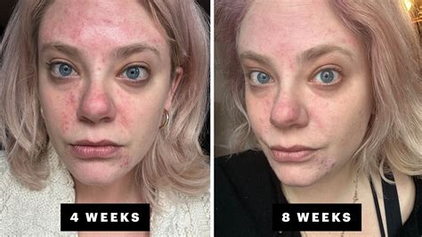 13. 19. r/SkincareAddiction. Join. • 28 days ago. [PSA] I had swelling around my brain and started going deaf from doxycycline use : ( If you and your doctor are considering antibiotics for acne - PLEASE discuss the risk of intracranial hypertension and tinnitus (new OR worsening). Here’s what to look for: 738. 103.. 