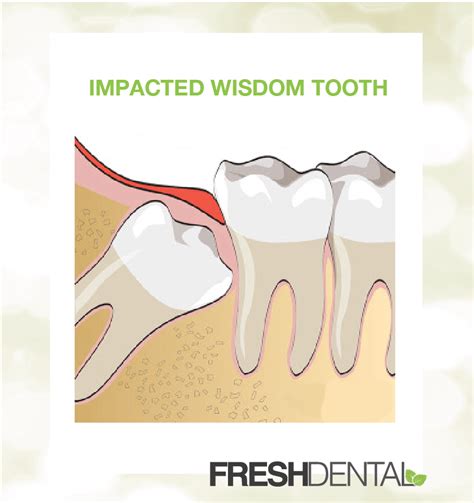 Wisdom Teeth Removal in Indian Trail NC Fresh Dental