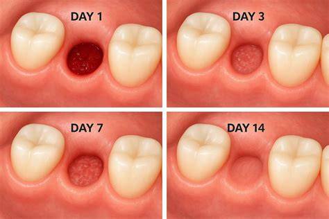 Wisdom tooth extraction day 6.  #wisdomteethremoval Smoking or vaping following wisdom tooth extr...