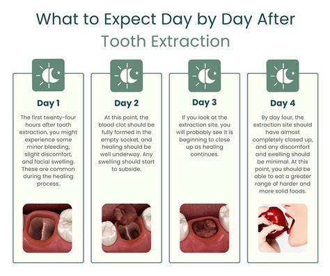 Wisdom tooth extraction healing stages pictures.  Our visual guide Learn ab...