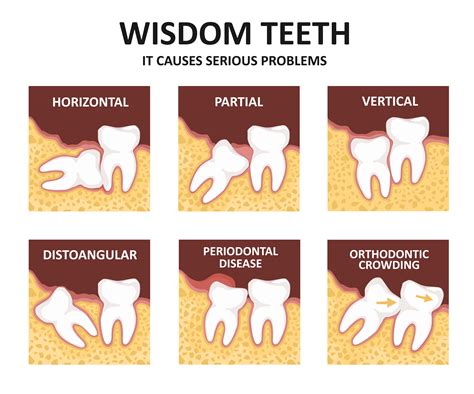 Wisdom tooth extraction side effects.  Wisdom teeth removal is a simple and routine surgic...