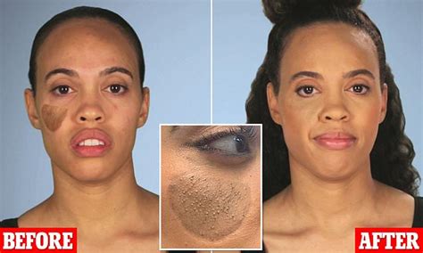 Woman was left with pubic hair on her FACE after skin graft